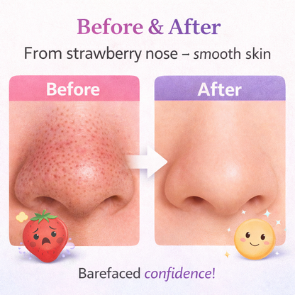 Velithra™ Blackhead Vacuum